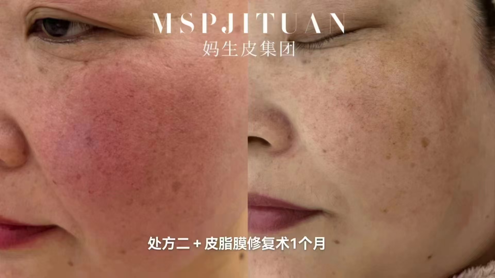 妈生皮皮脂膜修护护理记录示意