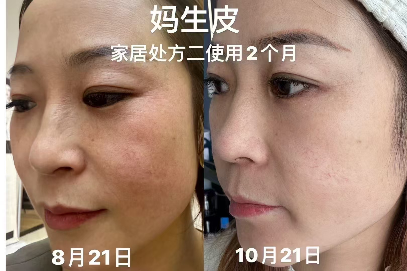 妈生皮家居处方护理记录示意