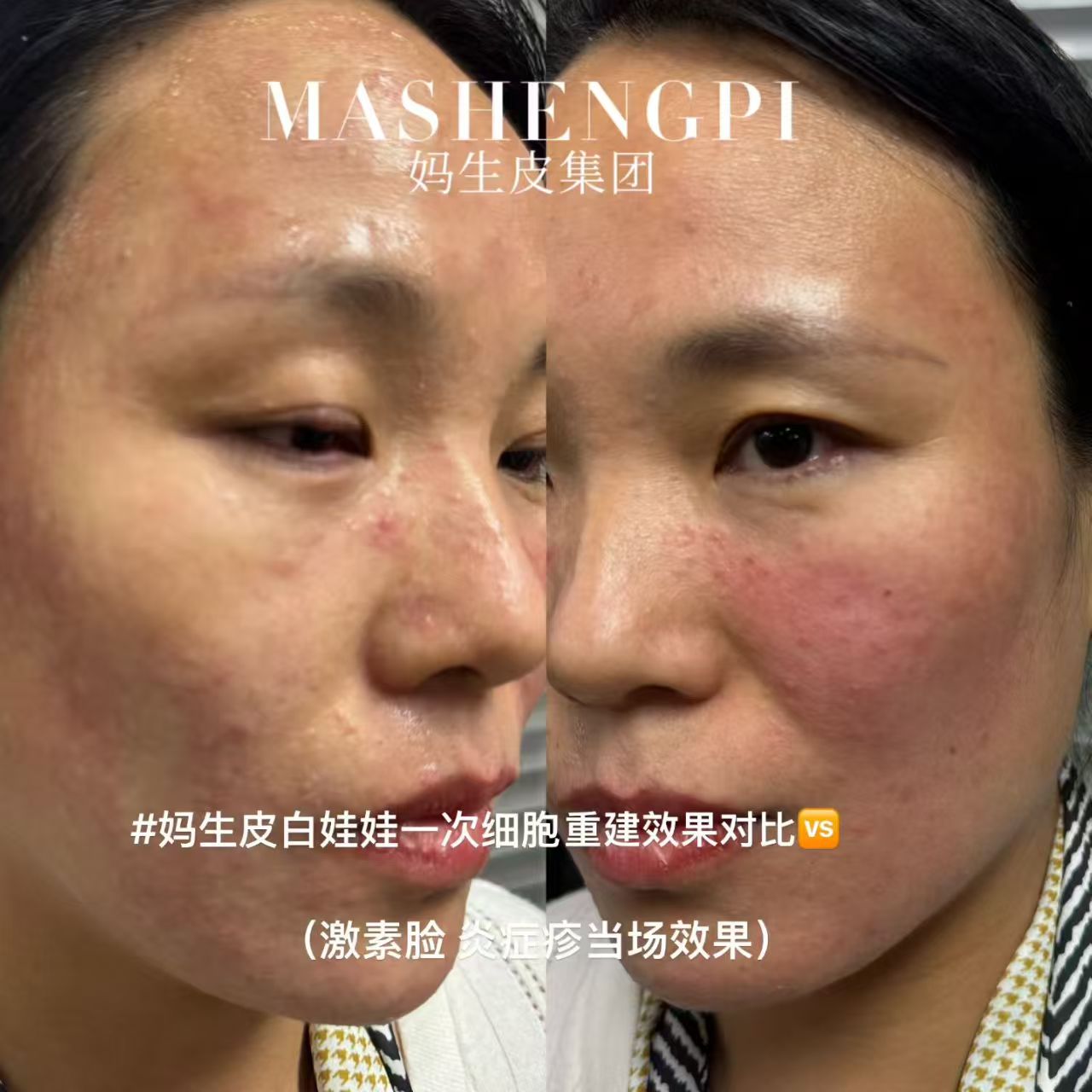 妈生皮特殊敏感状态护理记录示意