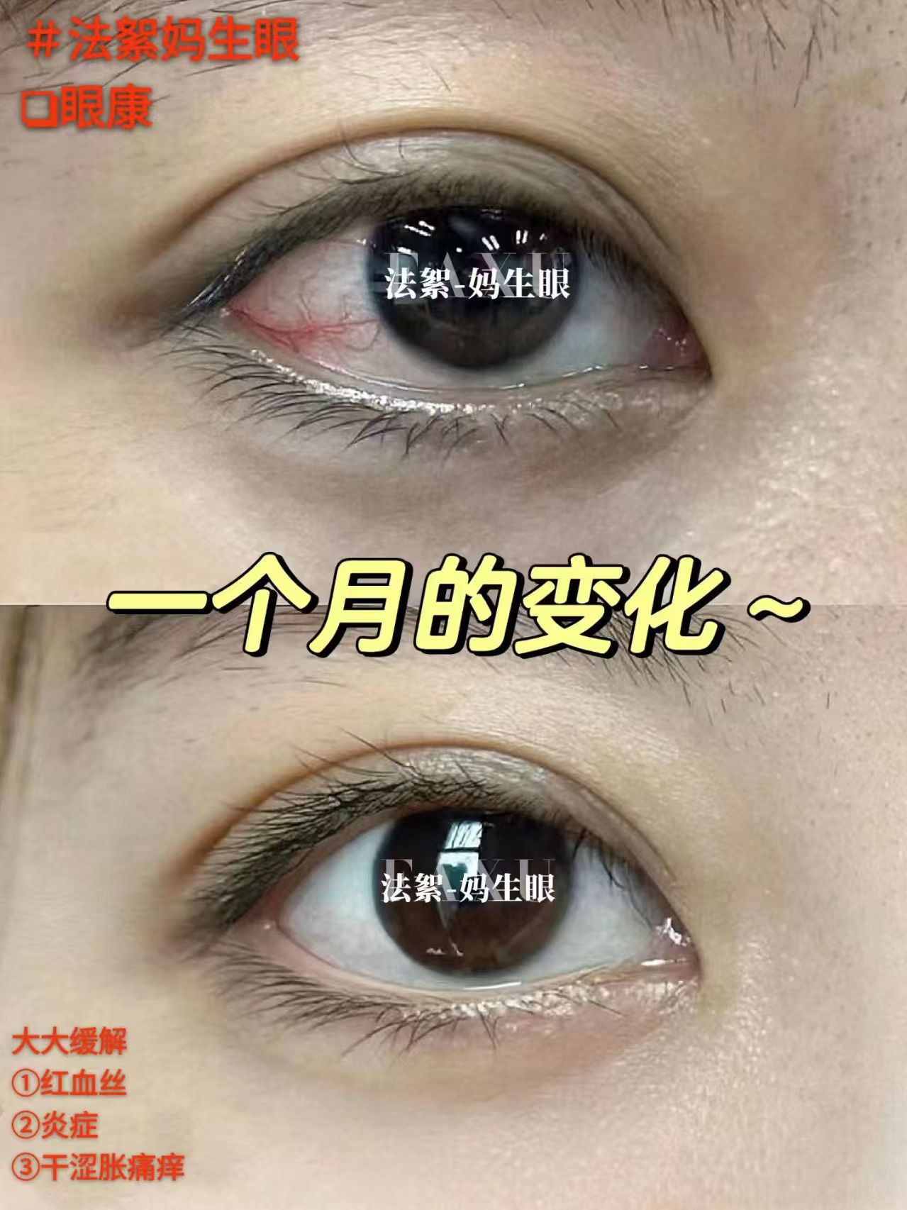 妈生皮妈生眼护理记录示意