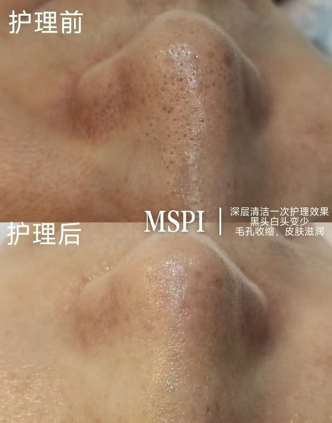 妈生皮三重清洁护理记录示意